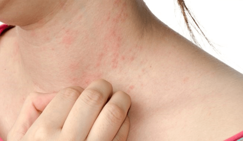 Herpes zóster tem se tornado comum, Dormência, Prurido, Fatores de Risco para NPH, Diagnóstico da Neuralgia Pós-Herpética, Sintomas da Neuralgia Pós-Herpética